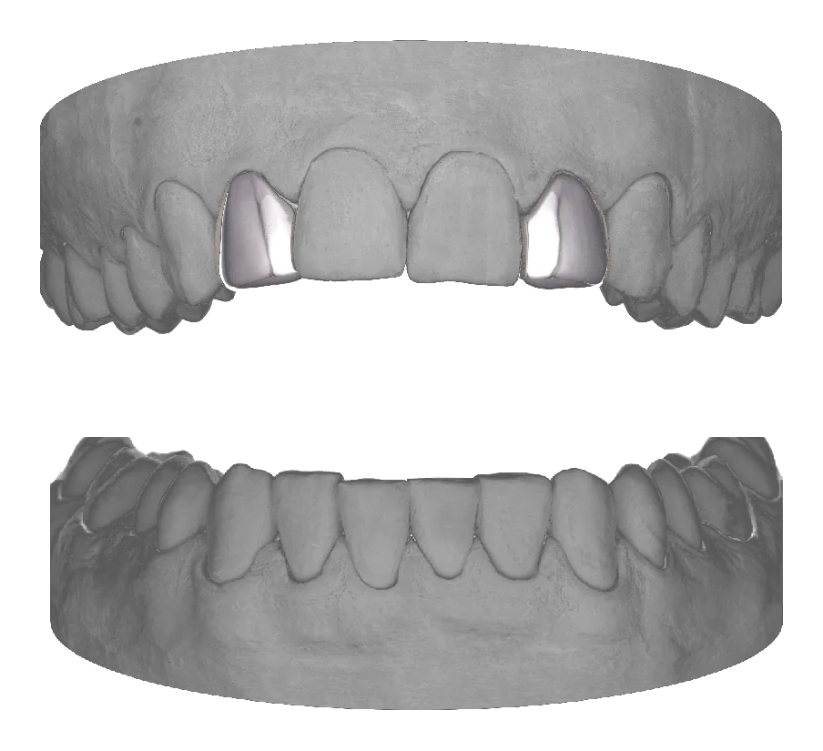 Lateral Lateral Upper