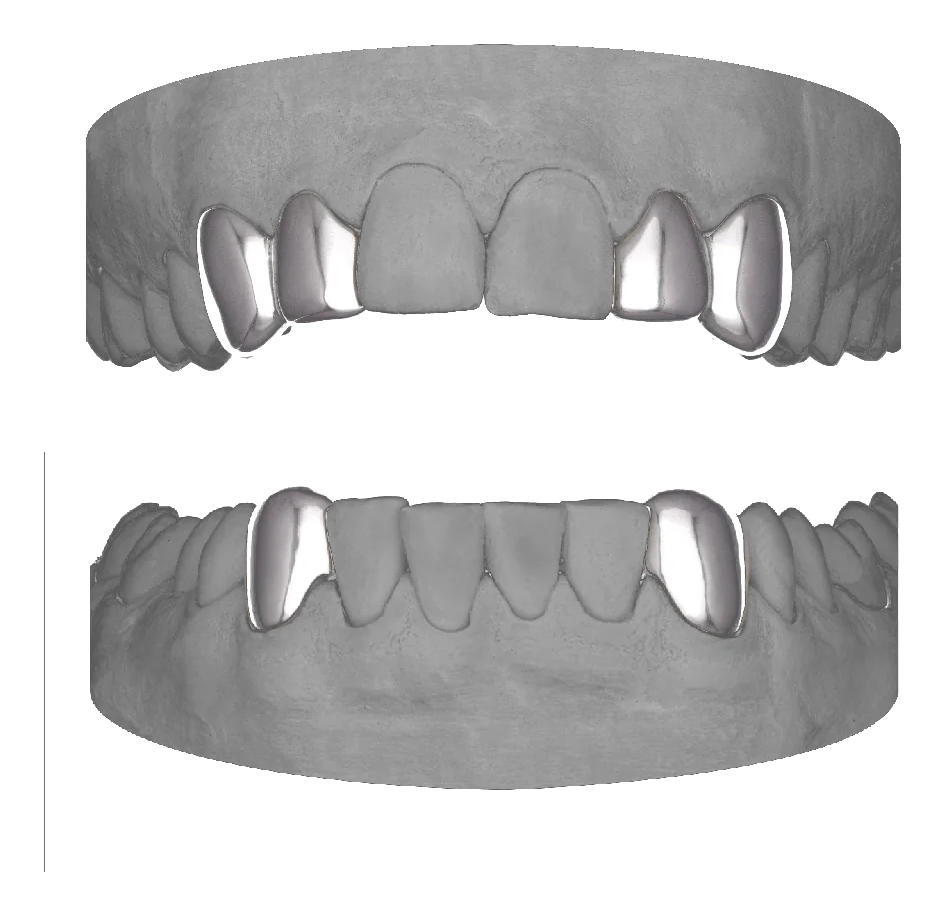 2x2 Canine and Lateral Bottom Canines