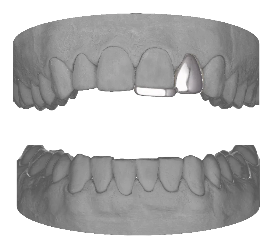 Lateral Bar