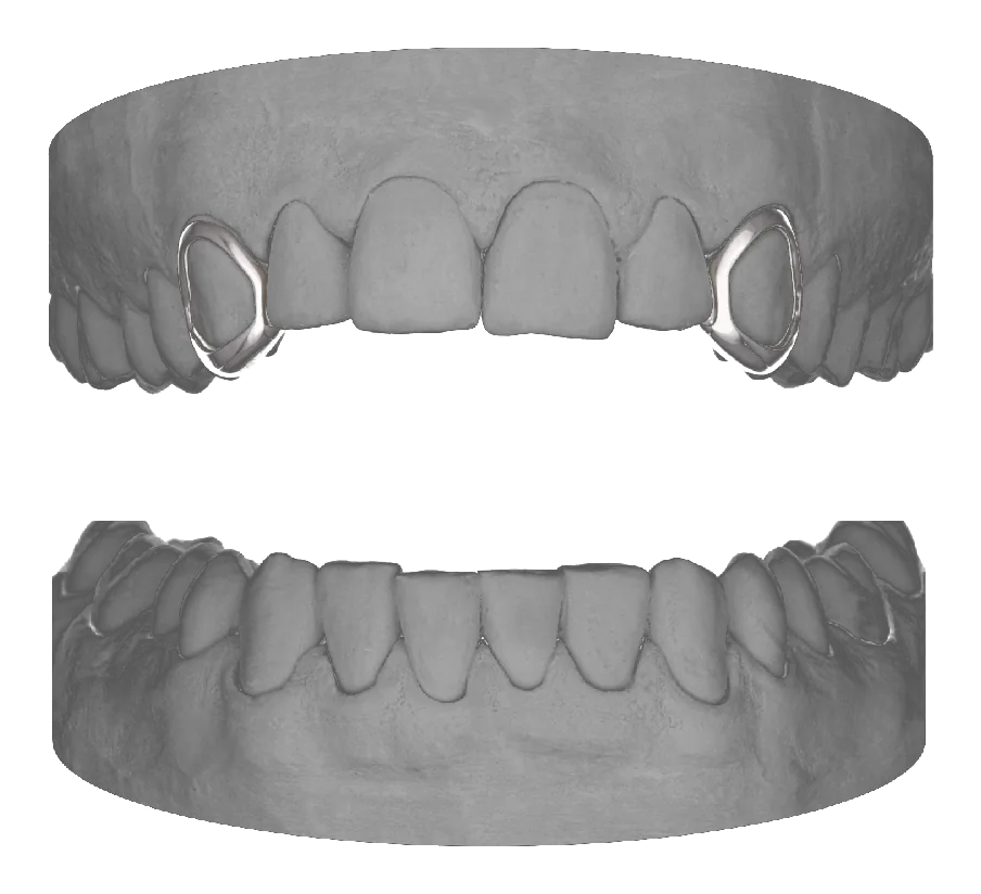 2x Window Canines Upper